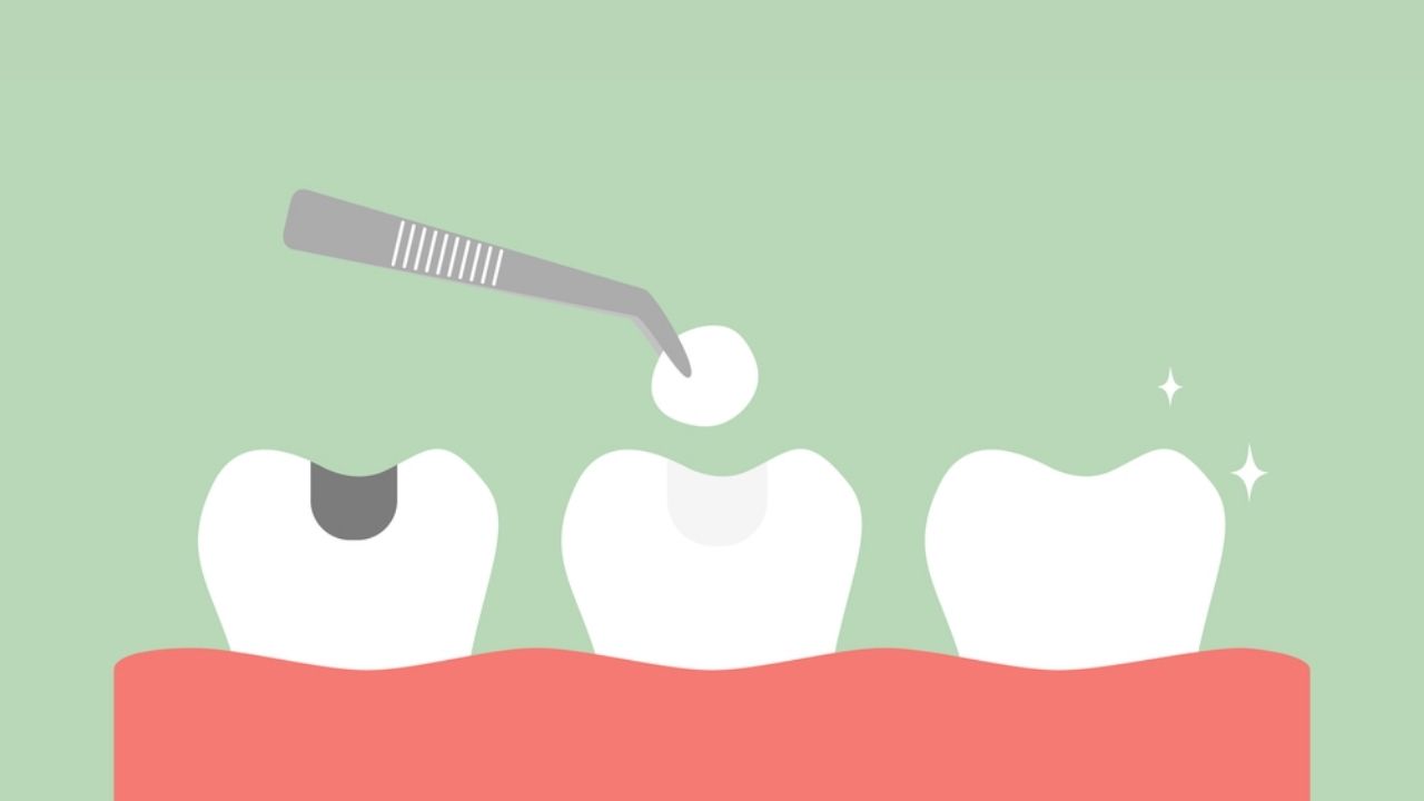 Como funciona o bloco no dente