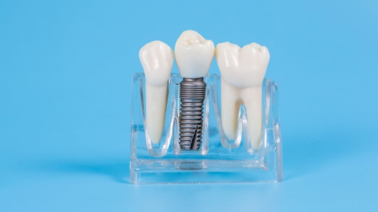 dente com uma prótese fixa