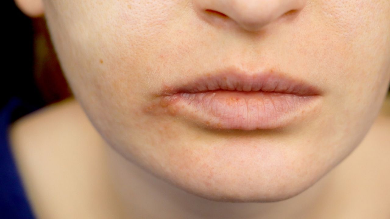 O que causa herpes na boca