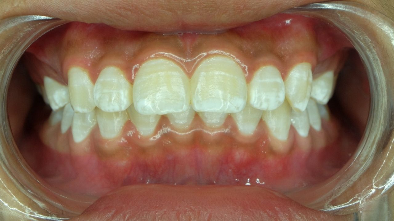 causas da mancha branca no dente