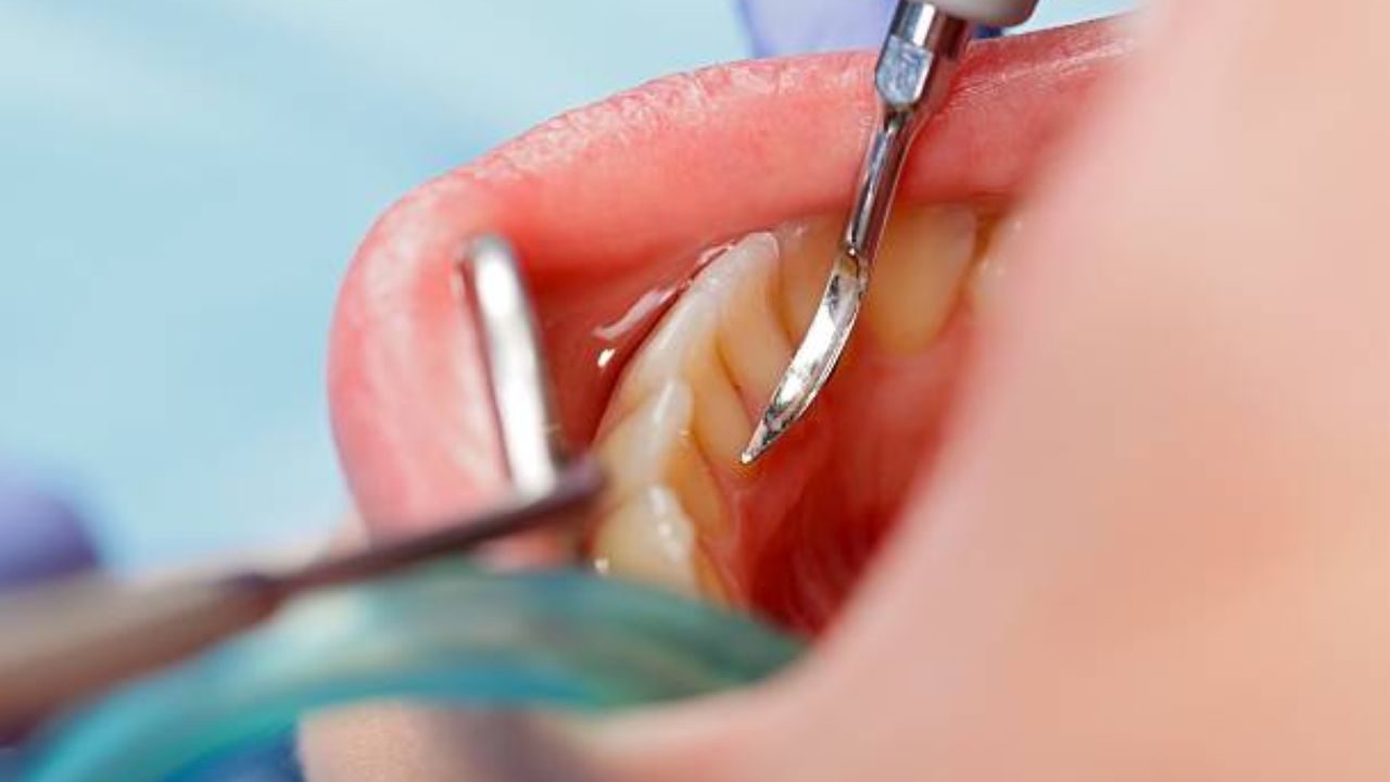 Zoom em boca de paciente recebendo a raspagem de tártaro de dentista