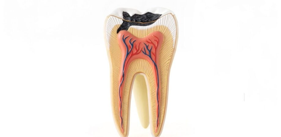 Ilustração de anatomia de dente com cárie