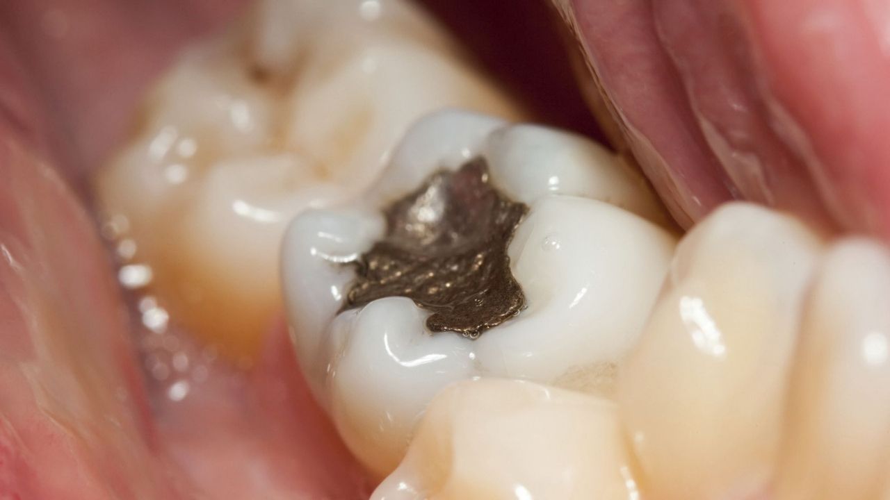 obturação de dente