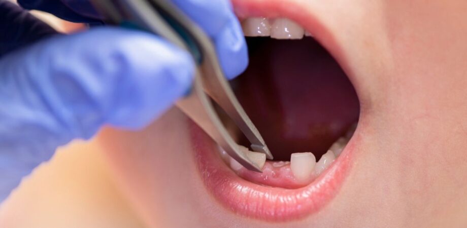 dentista mostrando se o dente de leite tem raiz
