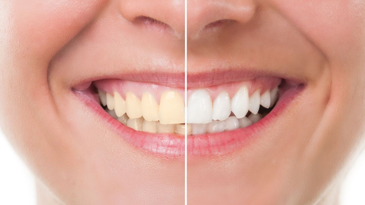 lente de contato dental antes e depois