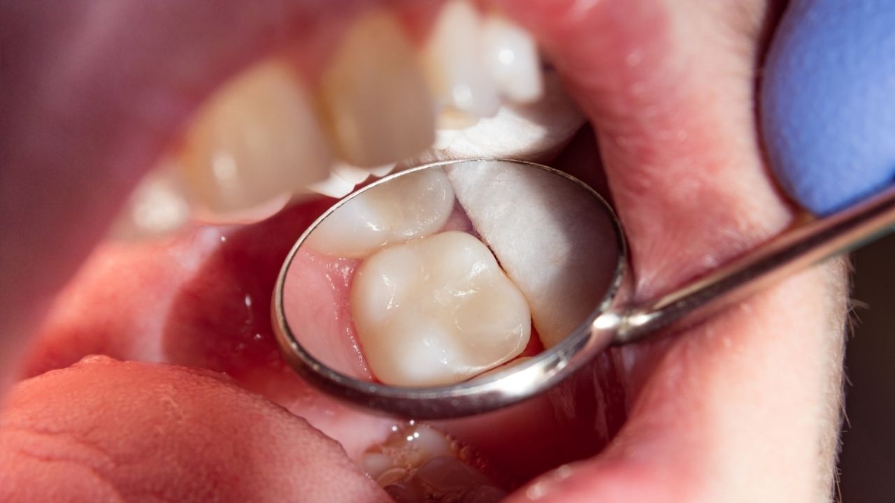 molar dente