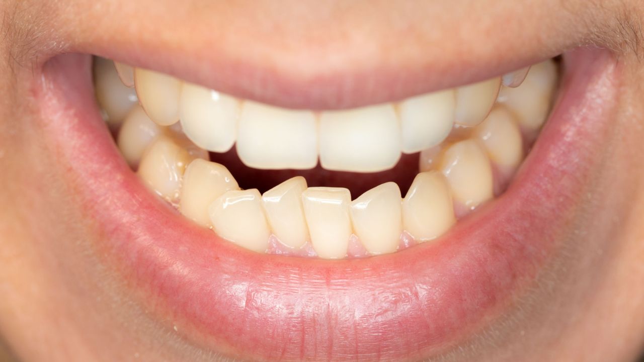 apinhamento ortodontia