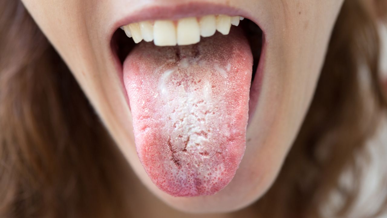 Qual doença deixa a língua branca?