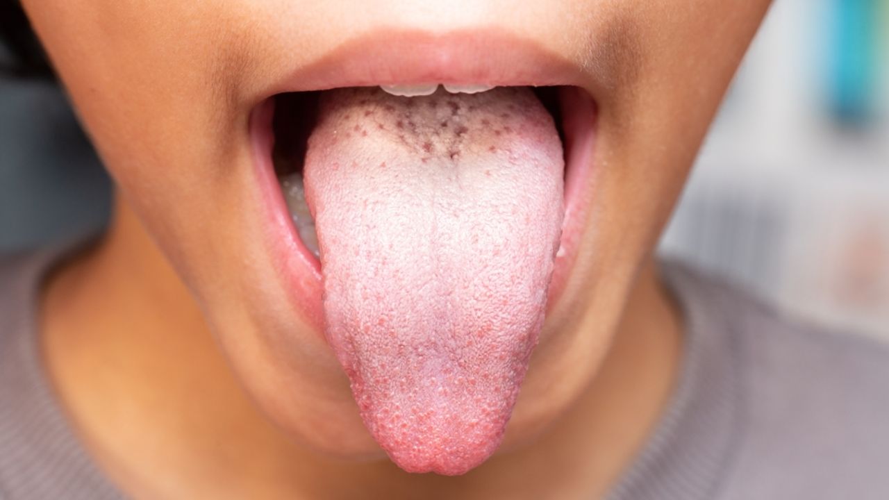 mancha branca na língua candidiase oral
