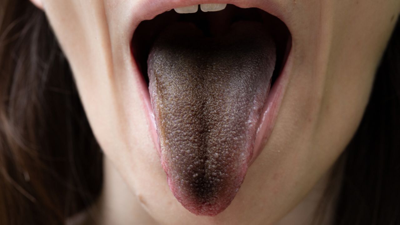 mancha escura na língua