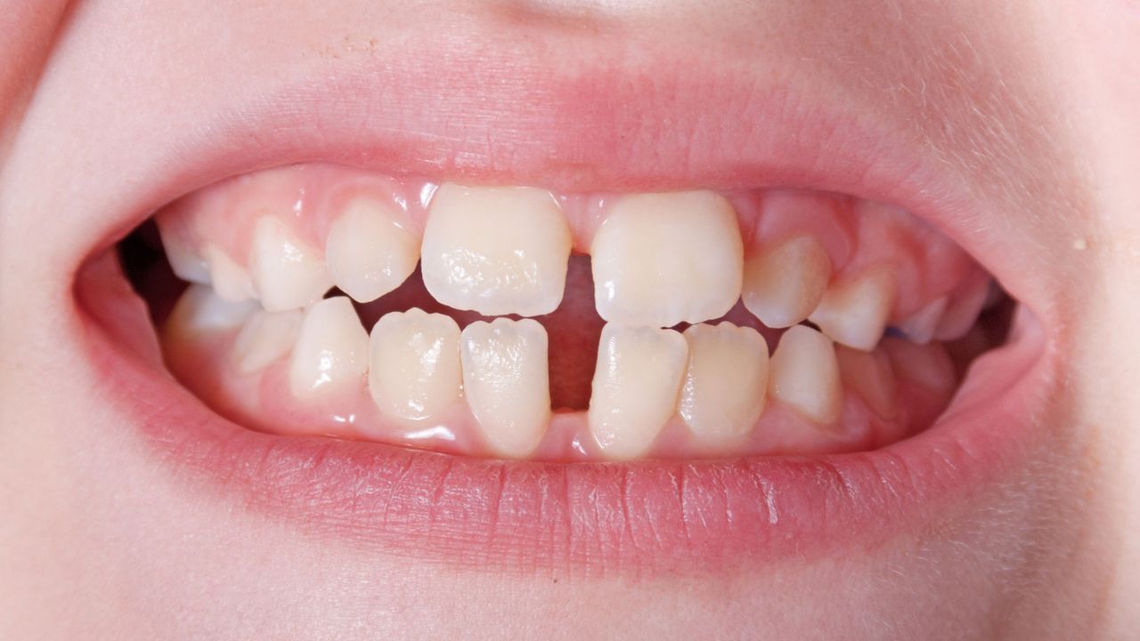 mordida aberta ortodontia