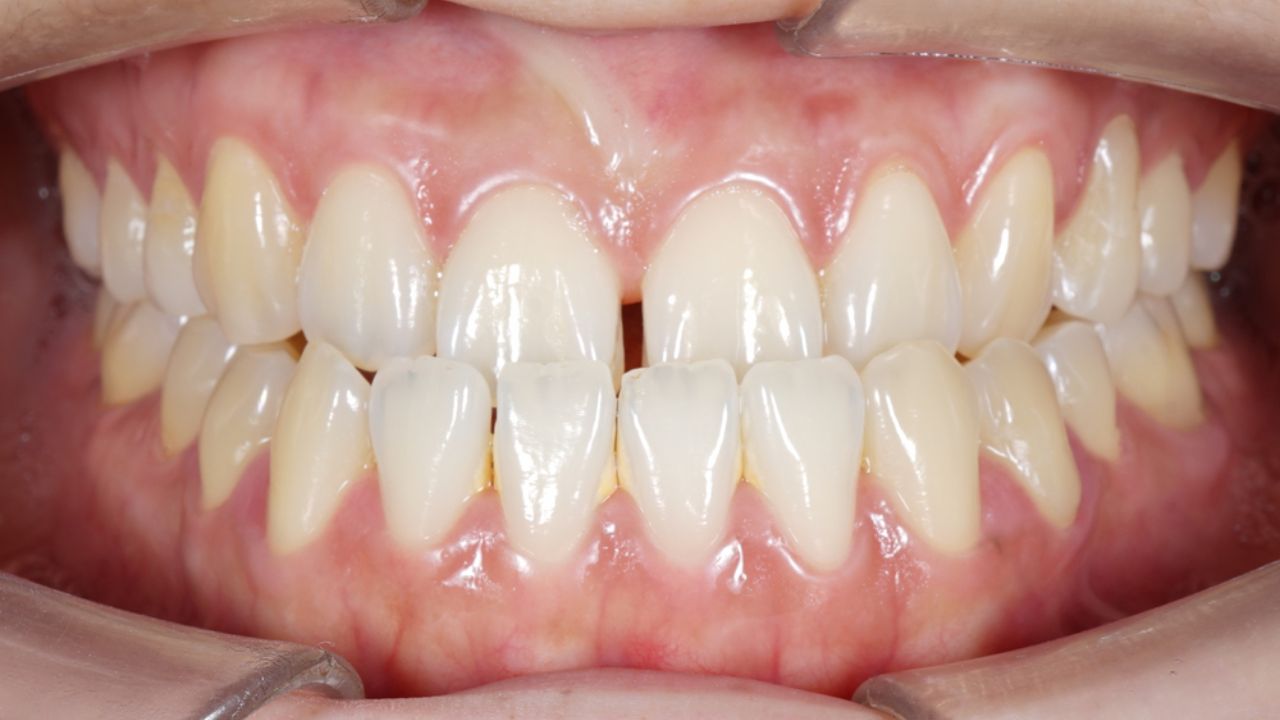 mordida cruzada ortodontia