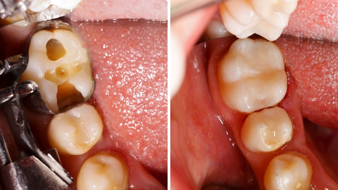 resina nos dentes restauração