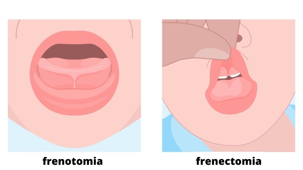 Qual a diferença entre frenectomia e frenotomia