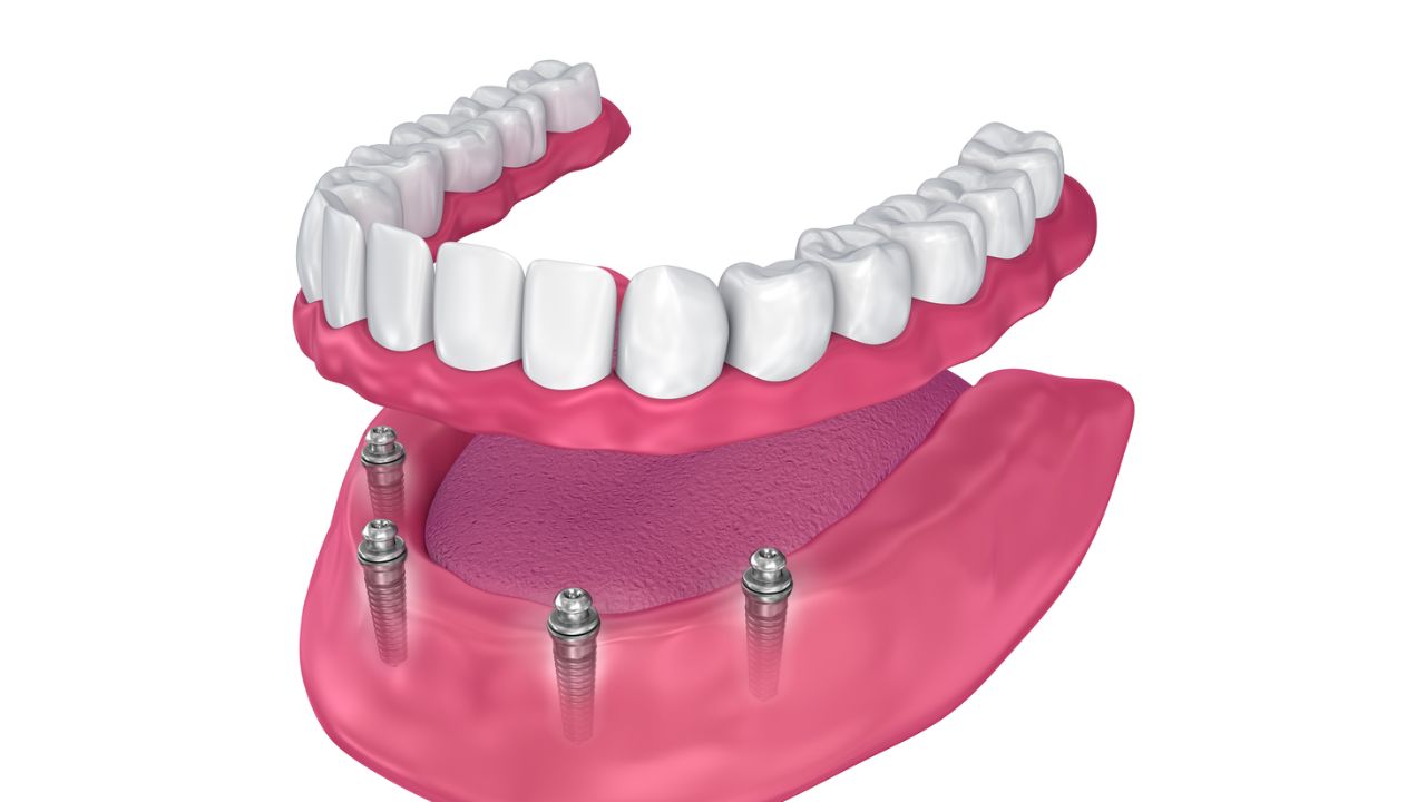 o que é prótese dentária overdenture