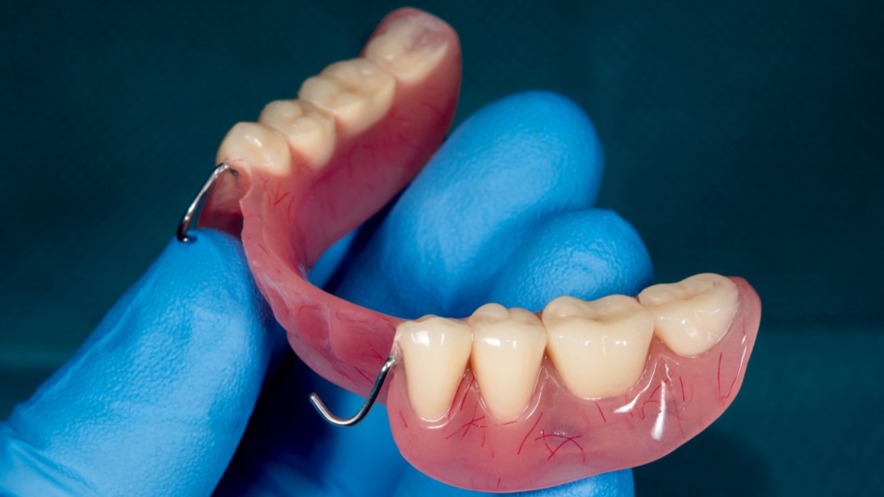 o que é prótese dentária parcial