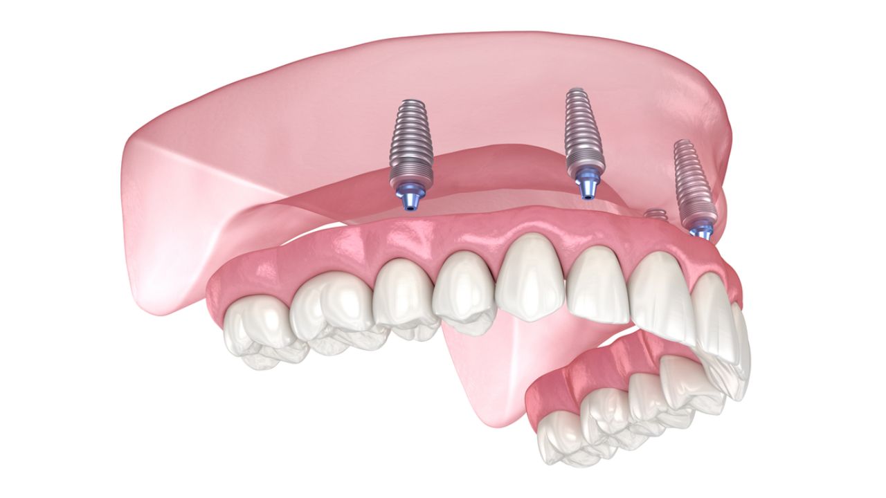 o que é prótese dentária protocolo