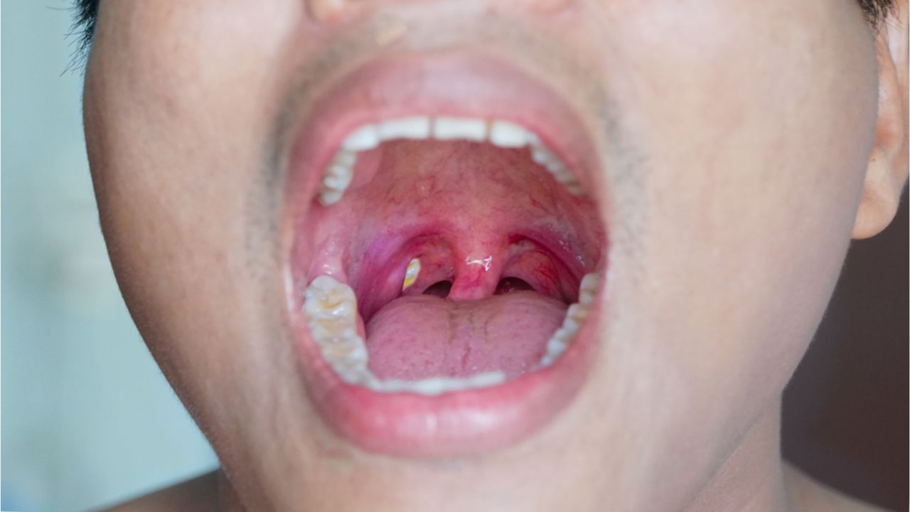 o que são bolinhas brancas na garganta