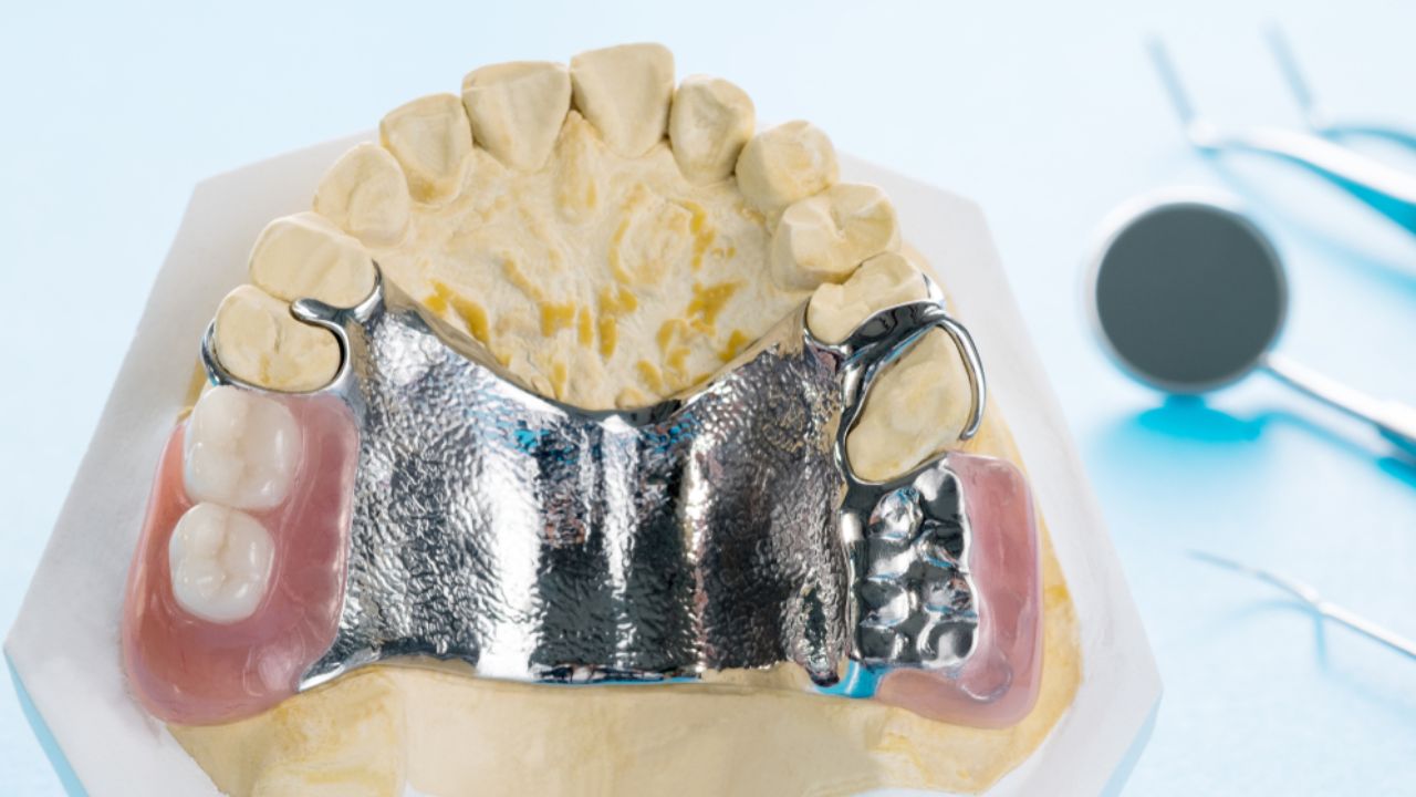 prótese dentária de encaixe