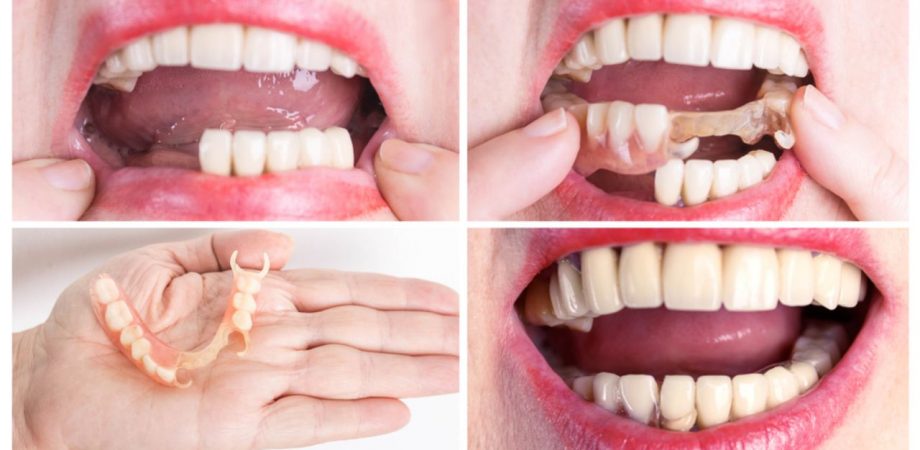 Prótese dentária de silicone: antes e depois do resultado!