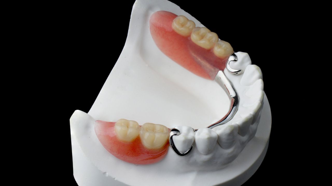protese dentaria removivel com encaixe