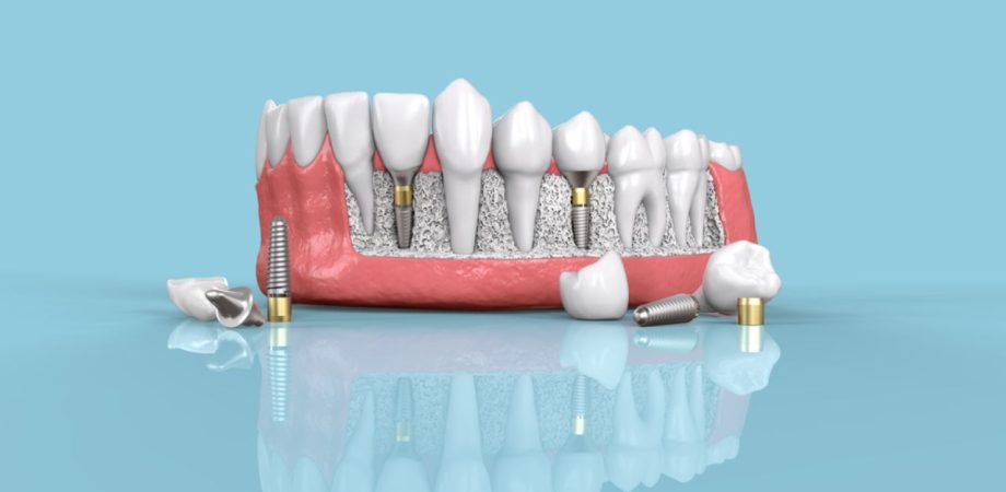 implante dentário dói