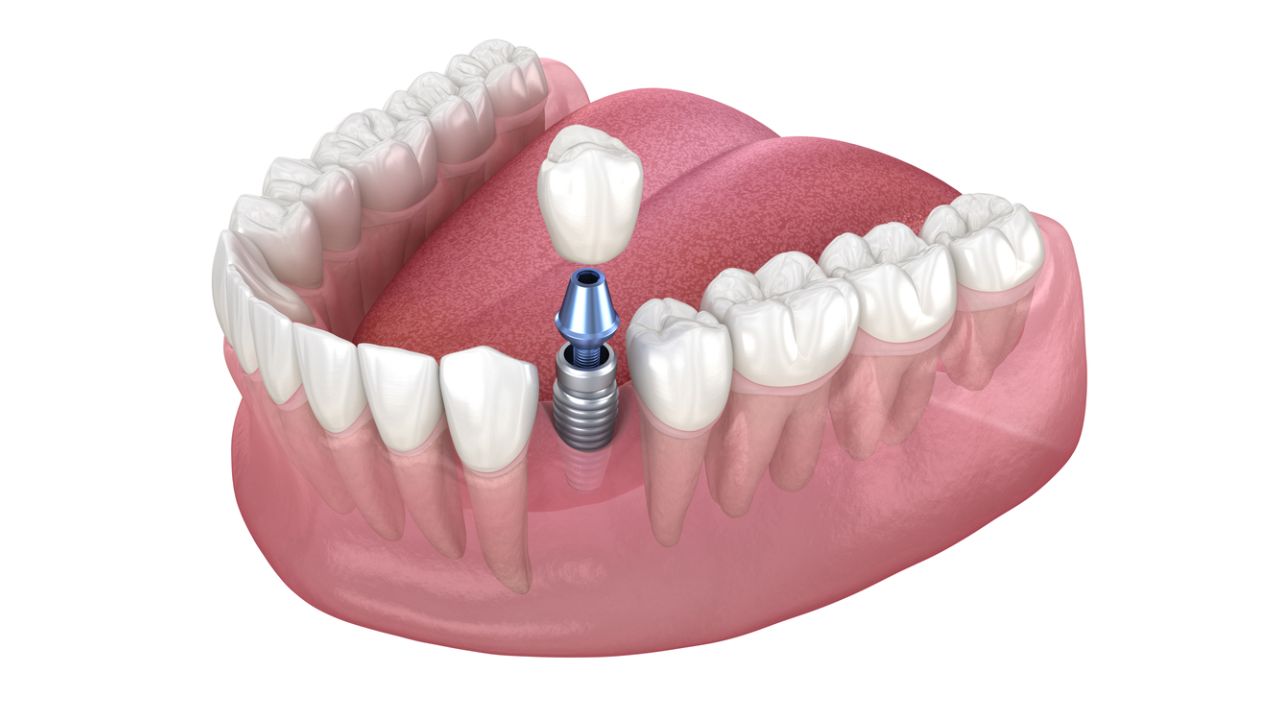 o que é implante dentário
