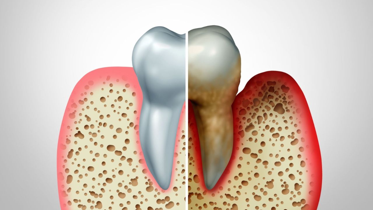o que é periodontite