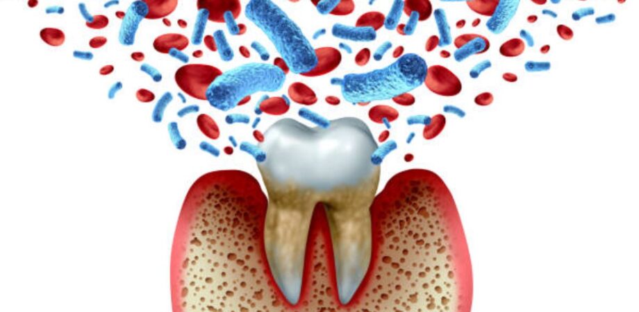 Ilustração de placa bacteriana em dente