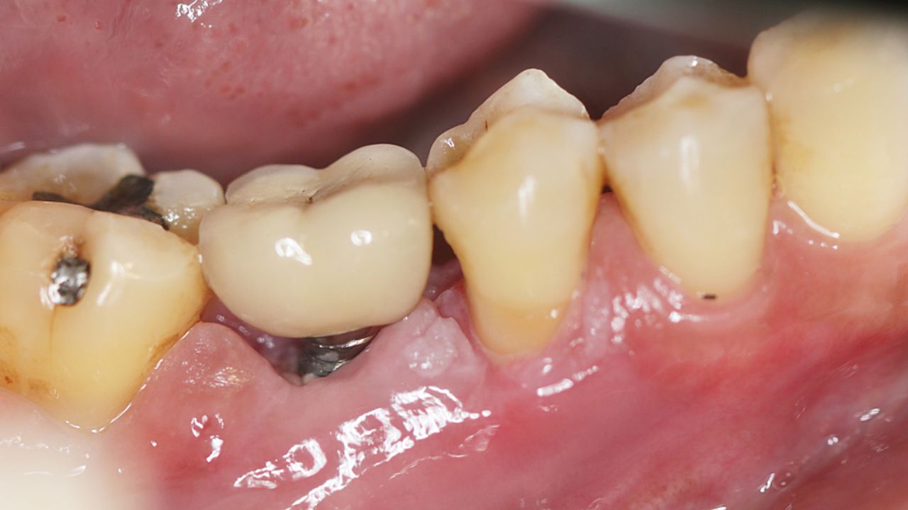 quais os sintomas de infecção no implante dentário