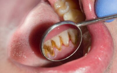 Zoom em tártaro na parte de trás da arcada dentária inferior de paciente
