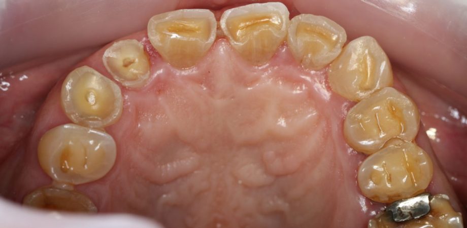 erosão dentária