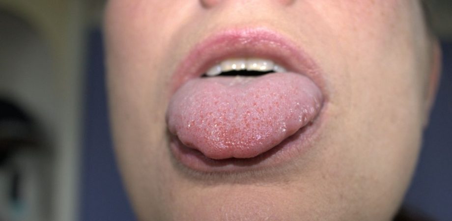 bolinhas na língua