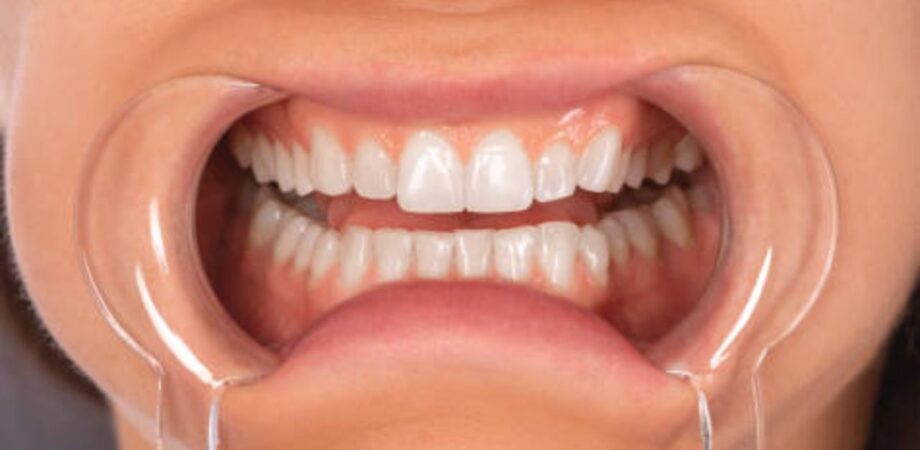 Sorriso de paciente após clareamento dental feito em consultório odontológico