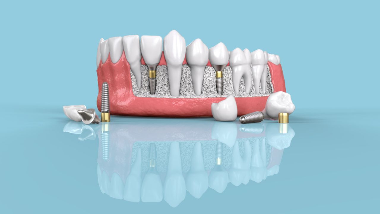 O que é implante dentário