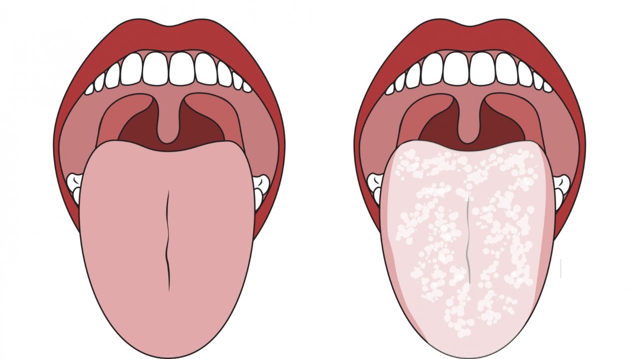 Desenho representando uma língua normal em contraste com língua com sapinho