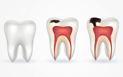 Ilustração mostrando a evolução da cárie no dente em 3 etapas