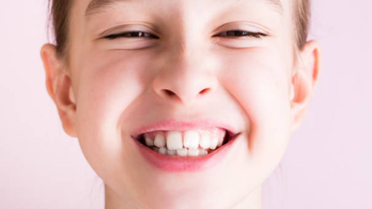 Zoom em rosto de criança sorrindo evidenciando dente desalinhado