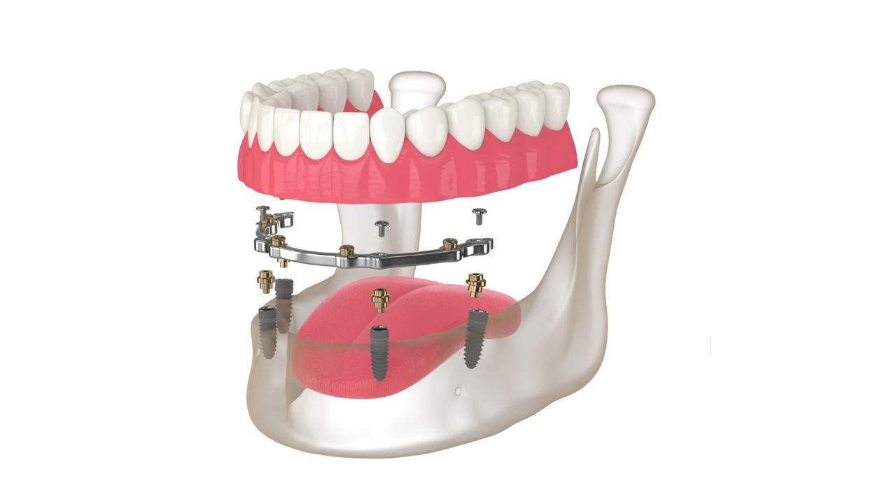 Ilustração mostrando prótese dentária protocolo sobre 4 pinos de titânio