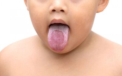 Criança com língua para fora mostrando sintomas de sapinho na boca