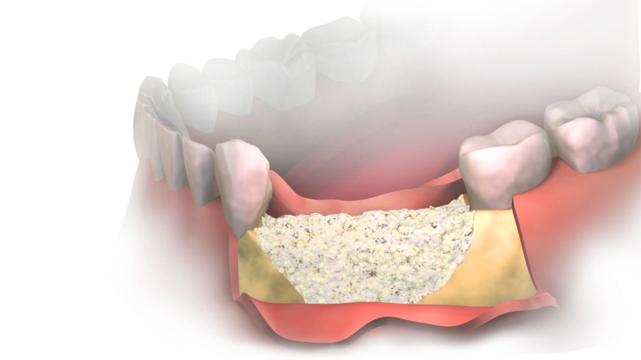 Tipos de enxerto ósseo dentário