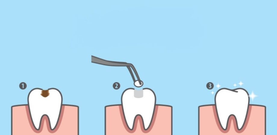 obturação de dente