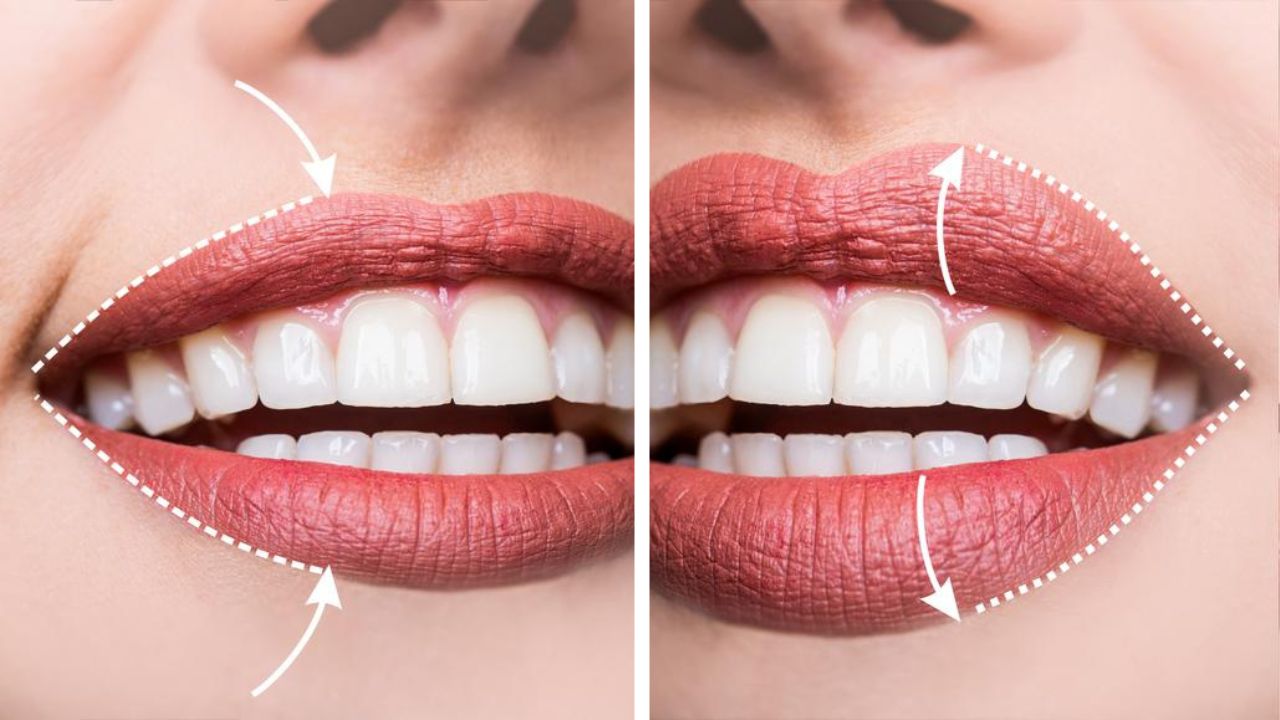 comparação do preenchimento labial antes e depois