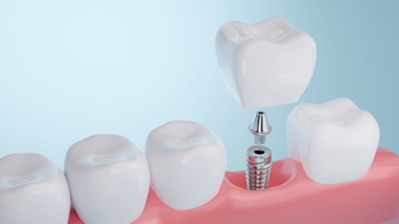 prótese sendo instalada sobre um implante dentário