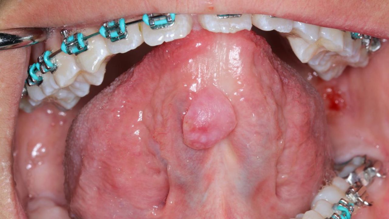 paciente com câncer de boca embaixo da língua