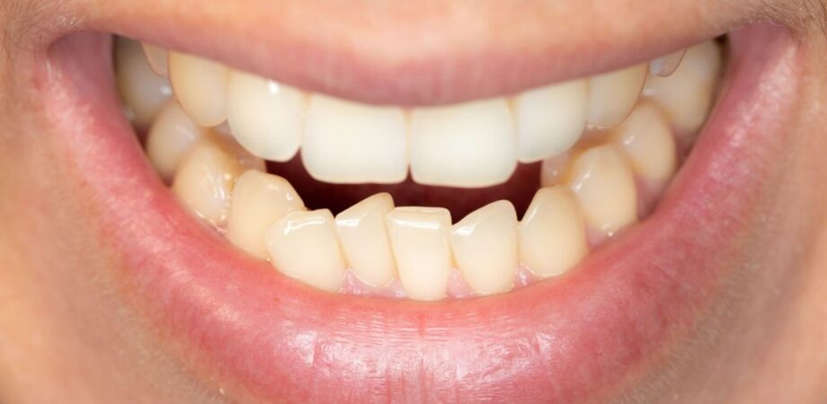 Zoom em boca de home com apinhamento dental