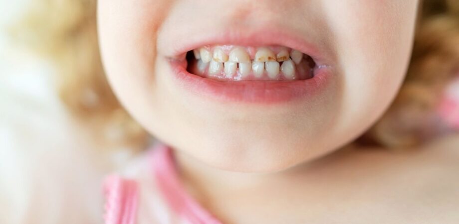 criança com cárie inicial entre os dentes da frente
