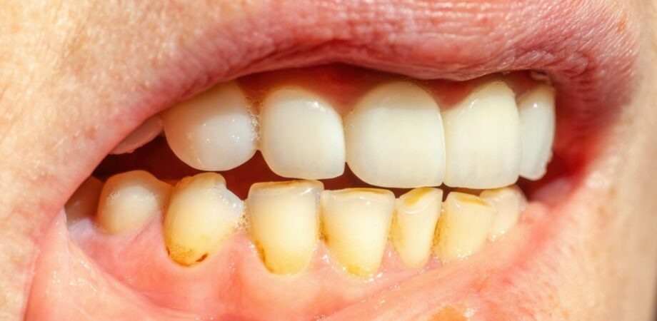 sorriso de um paciente com tártaro querendo saber o que causa tártaro nos dentes