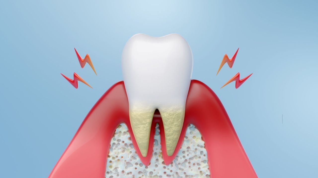 Ilustração mostrando prejuízos da periodontite no dente e gengiva