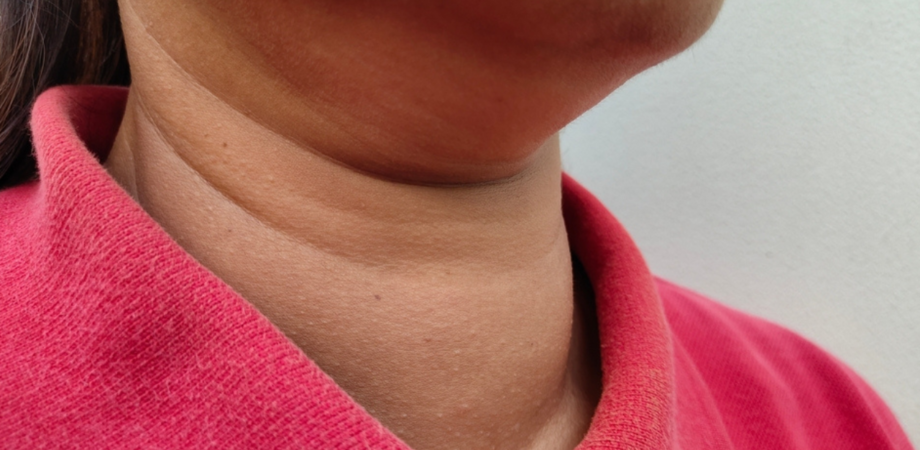 Uma mulher com o pescoço inchado, sintoma de angina de Ludwig.